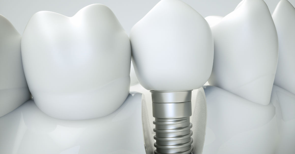 6 Ways We Prevent Your Dental Implant From Failing