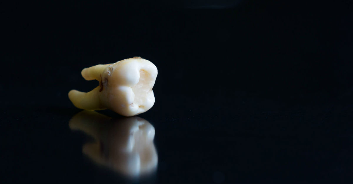 The Weirdest Dental Implants Throughout History