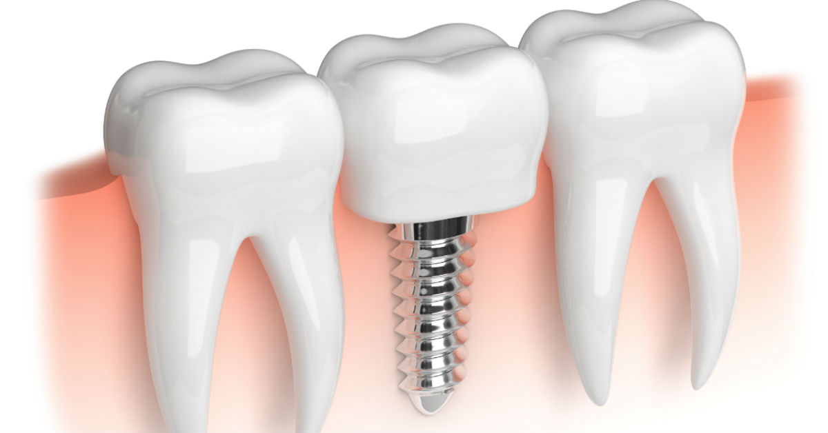 Advancements In Dental Implant Procedures