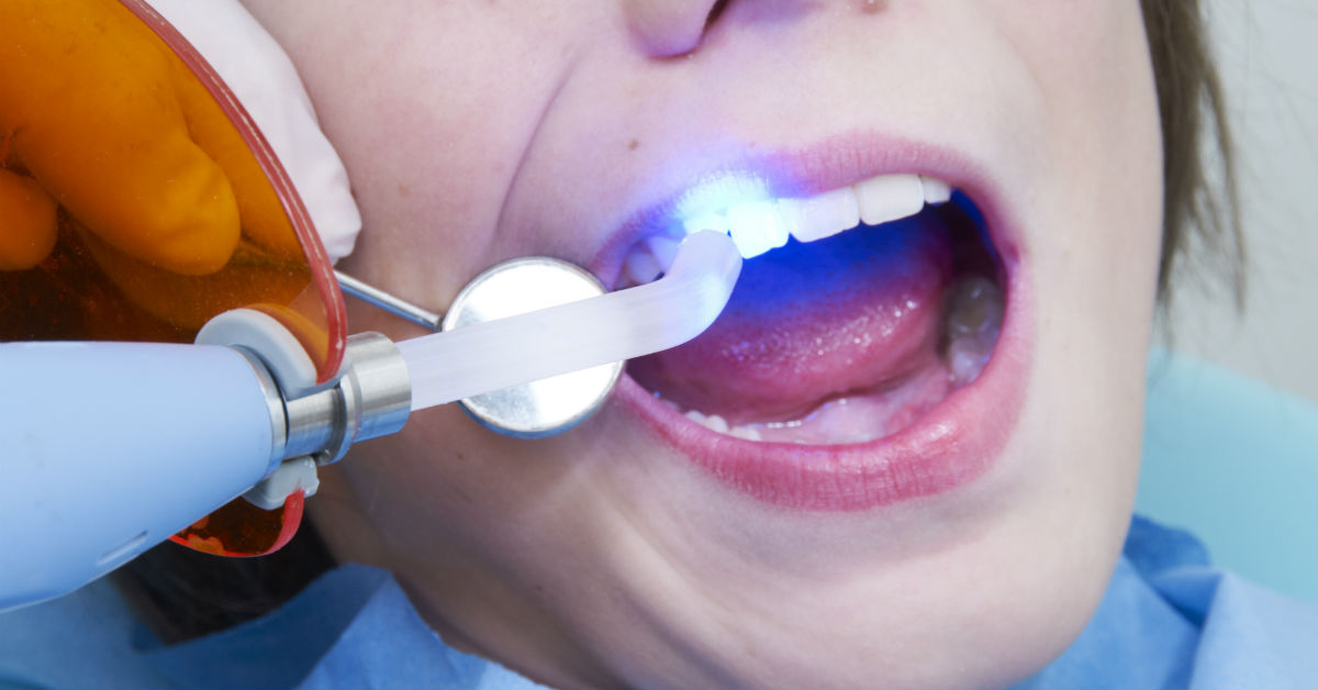 What Are Dental Sealants, Who Should Get Them, And How Long Do They Last