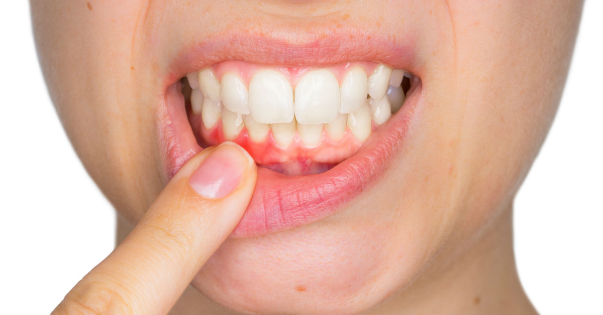 How to Identify and Fix Gingivitis