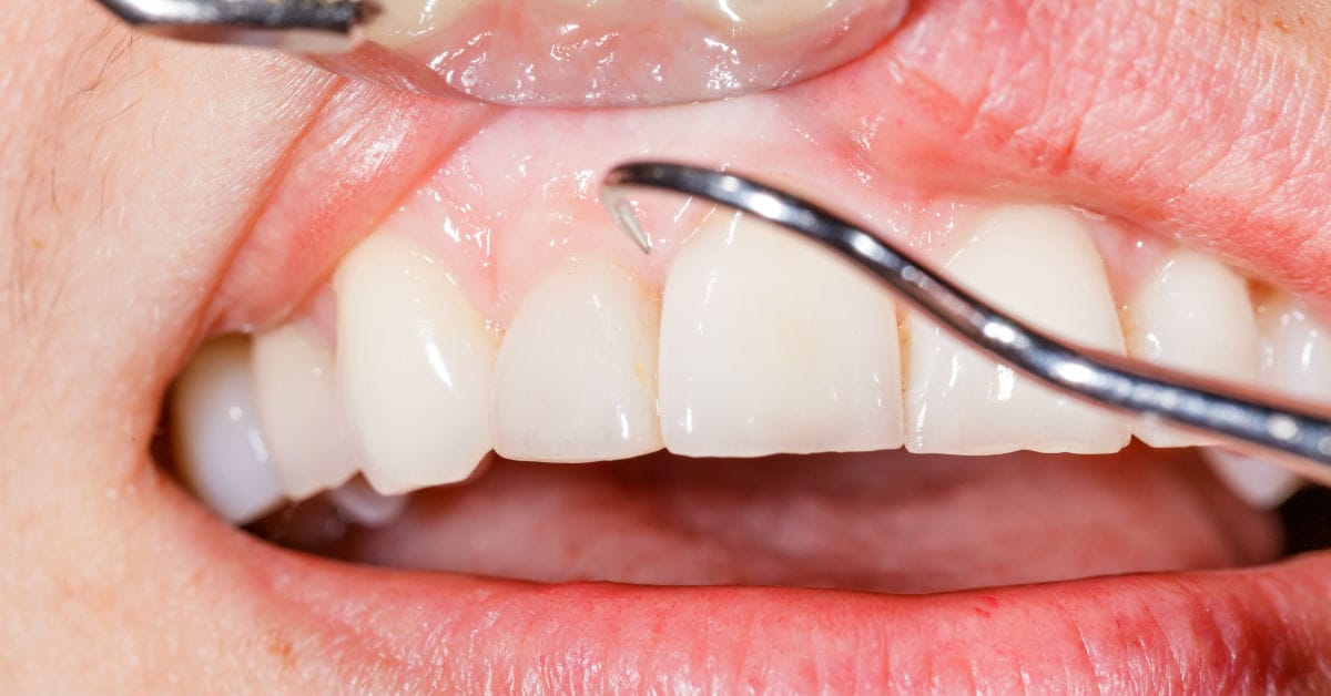 ​5 Reasons to Avoid Gingivitis Like It's the Plague