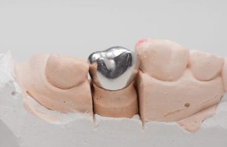 Metal-Dental-Crowns