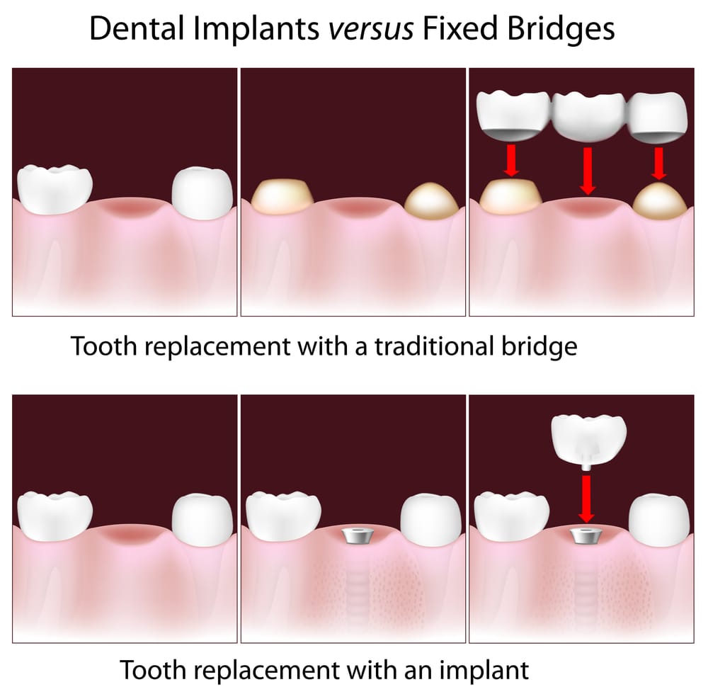 Dental Implants in Murrieta, CA