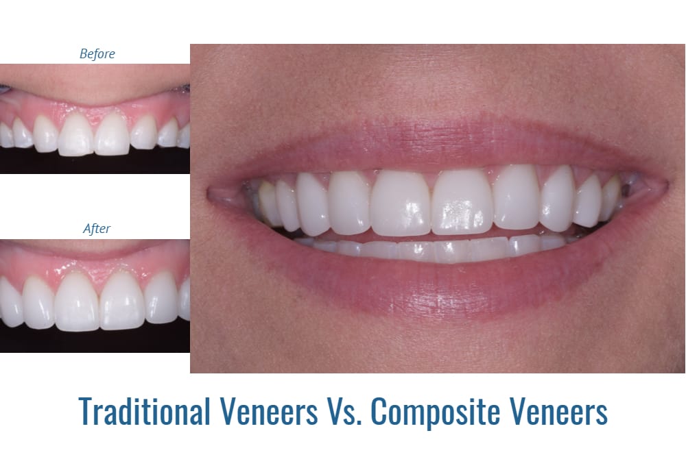 What Are The Differences Between Composite Resin Bonding & Veneers?