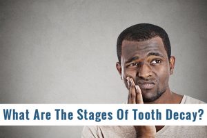 What Are The Stages Of Tooth Decay