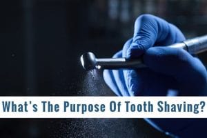 What Is The Purpose Of Tooth Shaving (1)