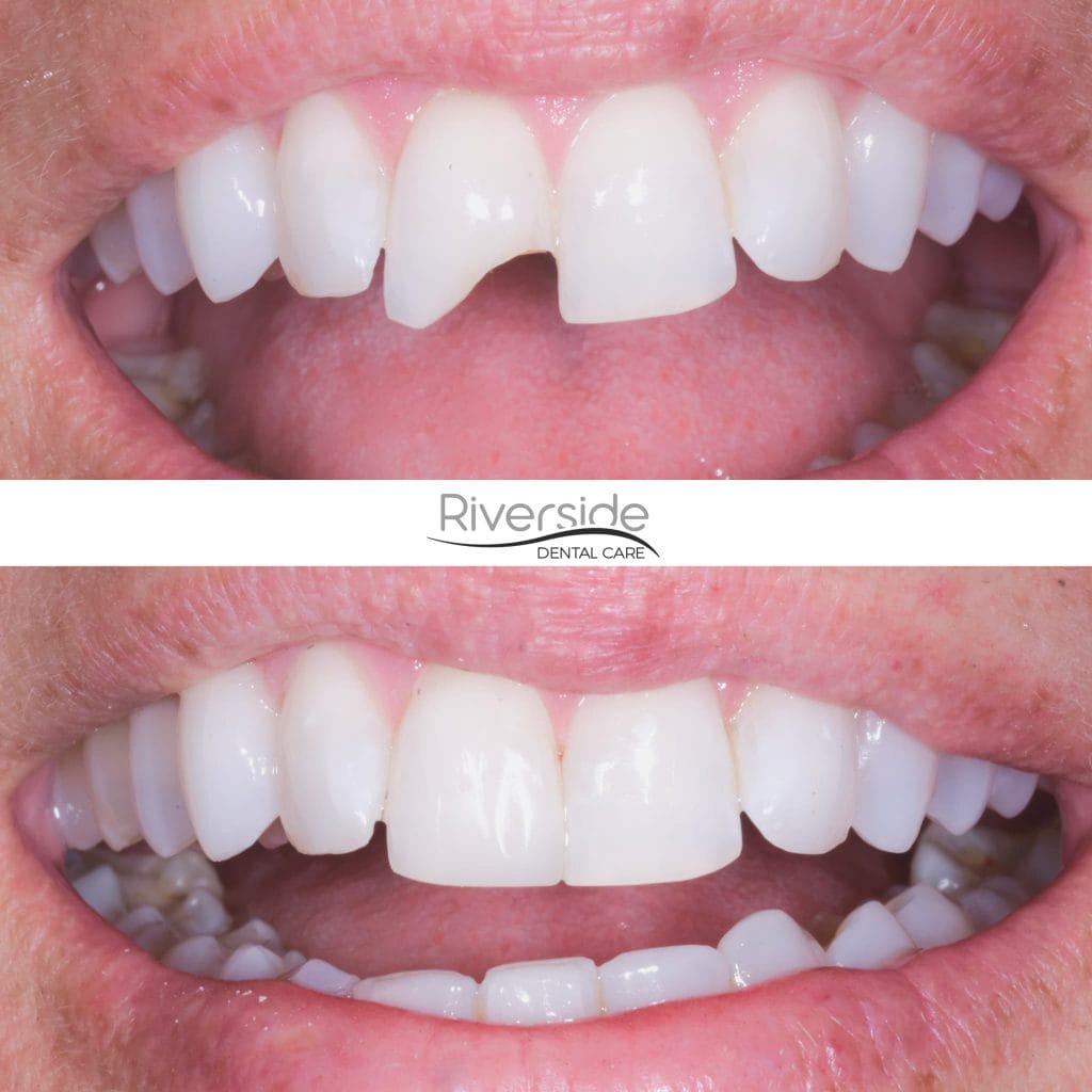 Riverside Chipped Tooth Before And After