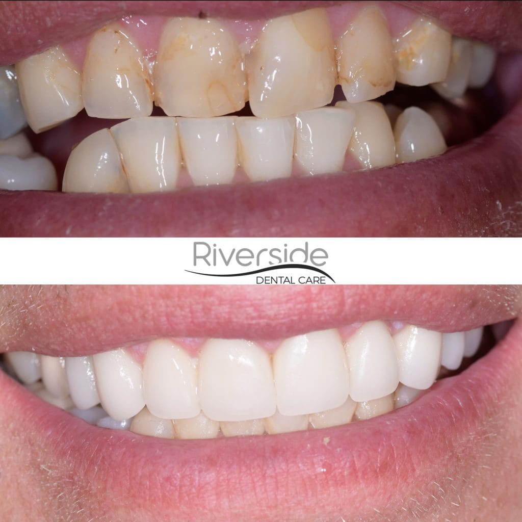 Riverside Crowns and Veneers Before and After