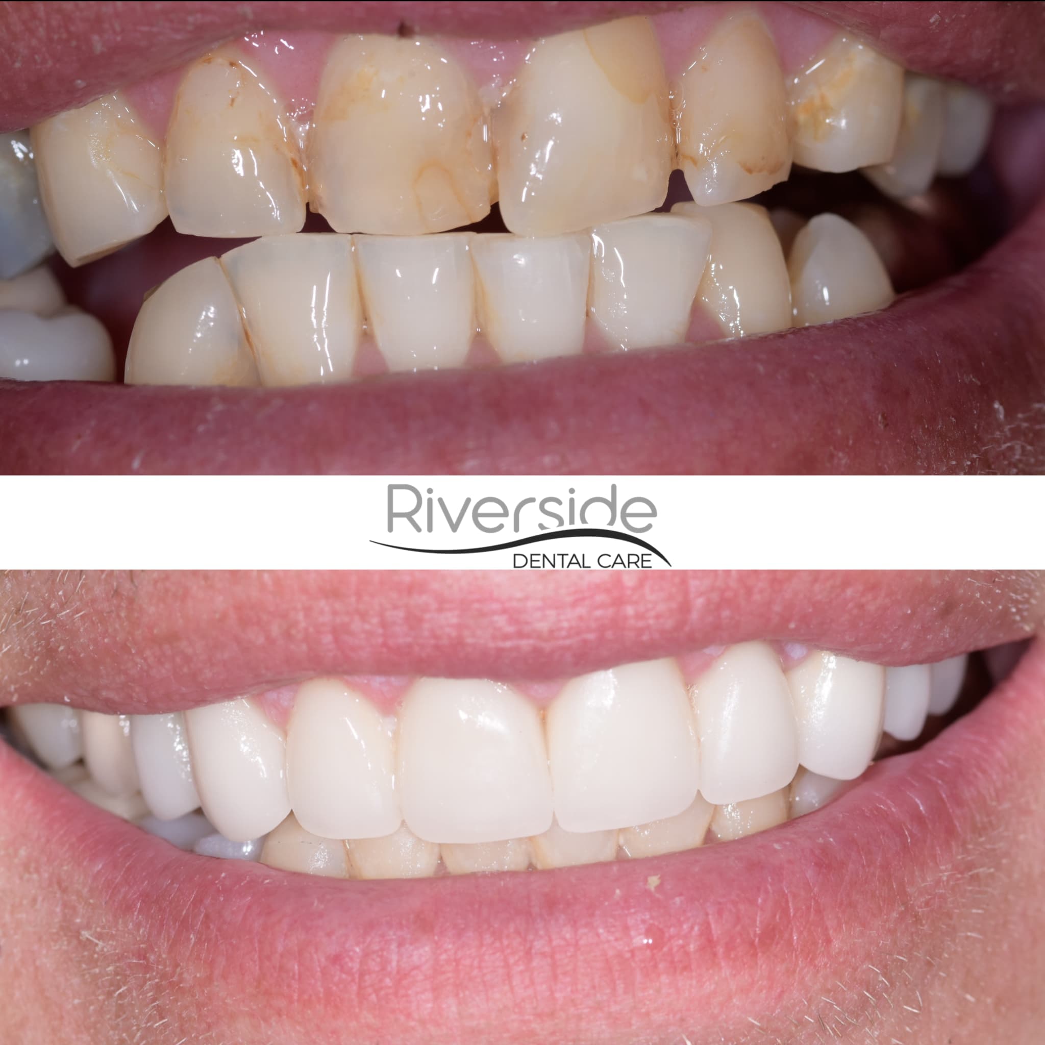 Riverside - Crowns and Veneers Before and After St George