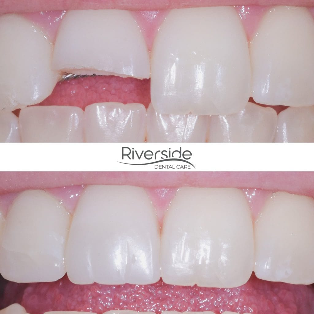 Riverside Dental Bonding Before And After