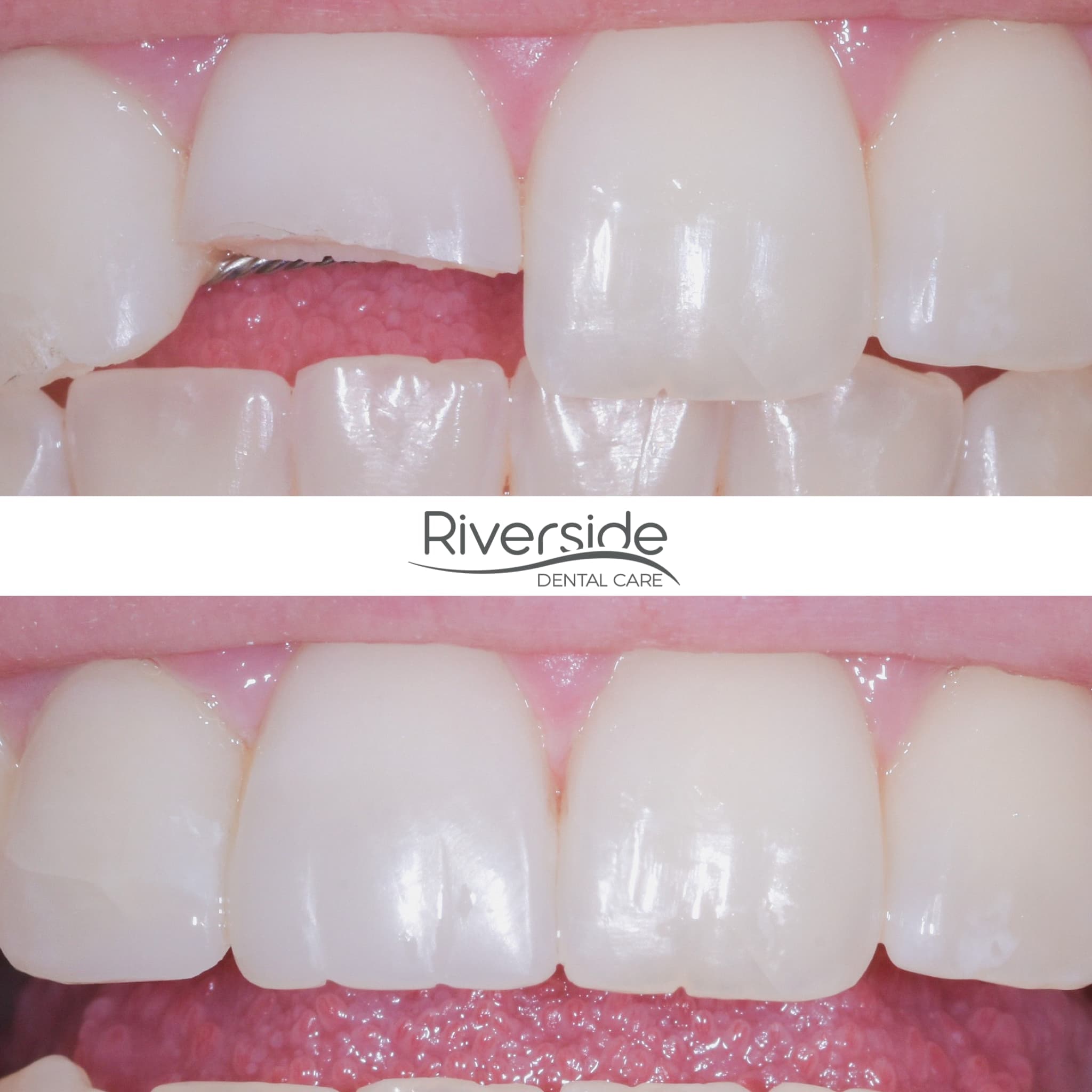 Riverside - Dental Bonding Before And After St George