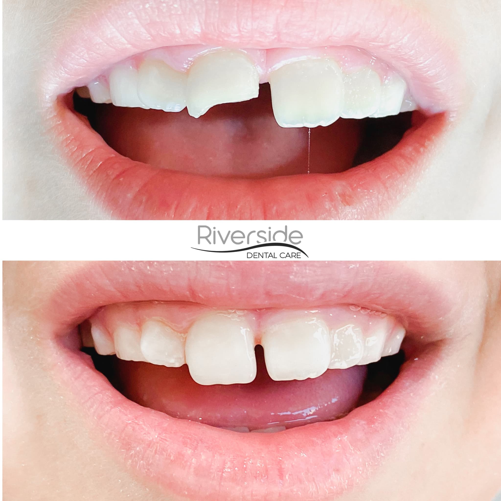 Riverside - Emergency Dental Before And After Picture