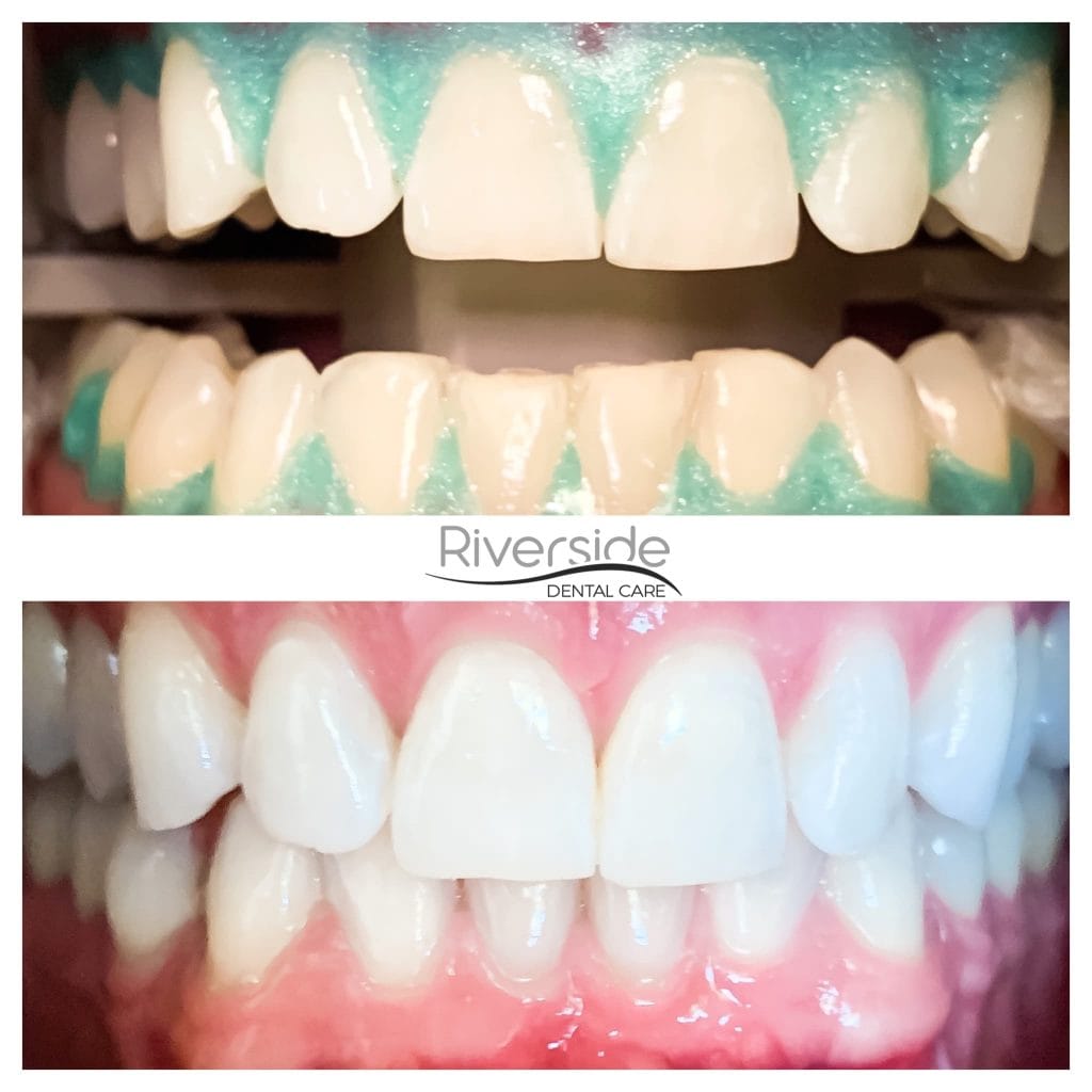 Riverside Teeth Whitening Before and After 