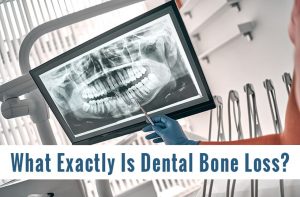 What Is Dental Bone Loss
