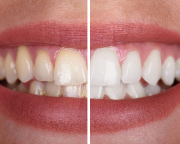 Teeth Whitening Riverside Dental