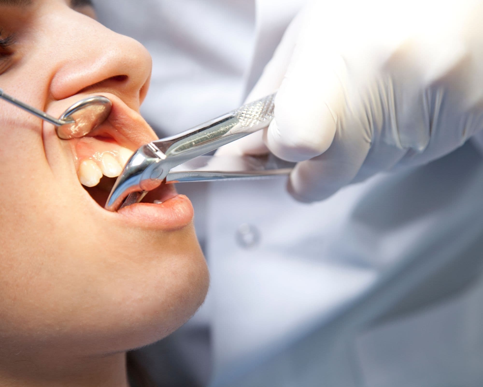 Tooth extraction. Стоматологическая хирургия щека. Кисты челюстей хирургическая стоматология.