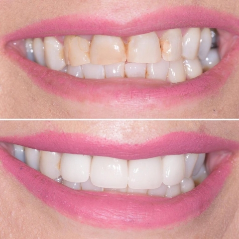 Smile Makeover Riverside Dental St George