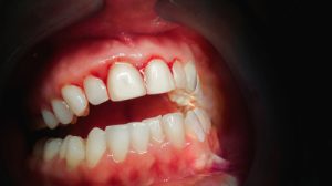 periodontal disease st george
