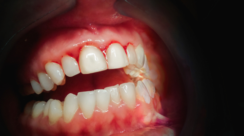 periodontal disease st george 