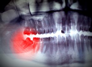 wisdom teeth removal