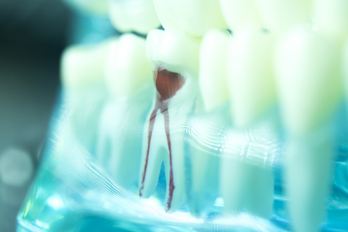 root canal and crown