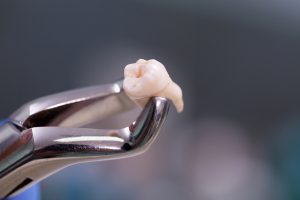 tooth extraction st george utah
