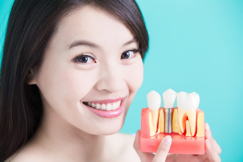 Dental Implants