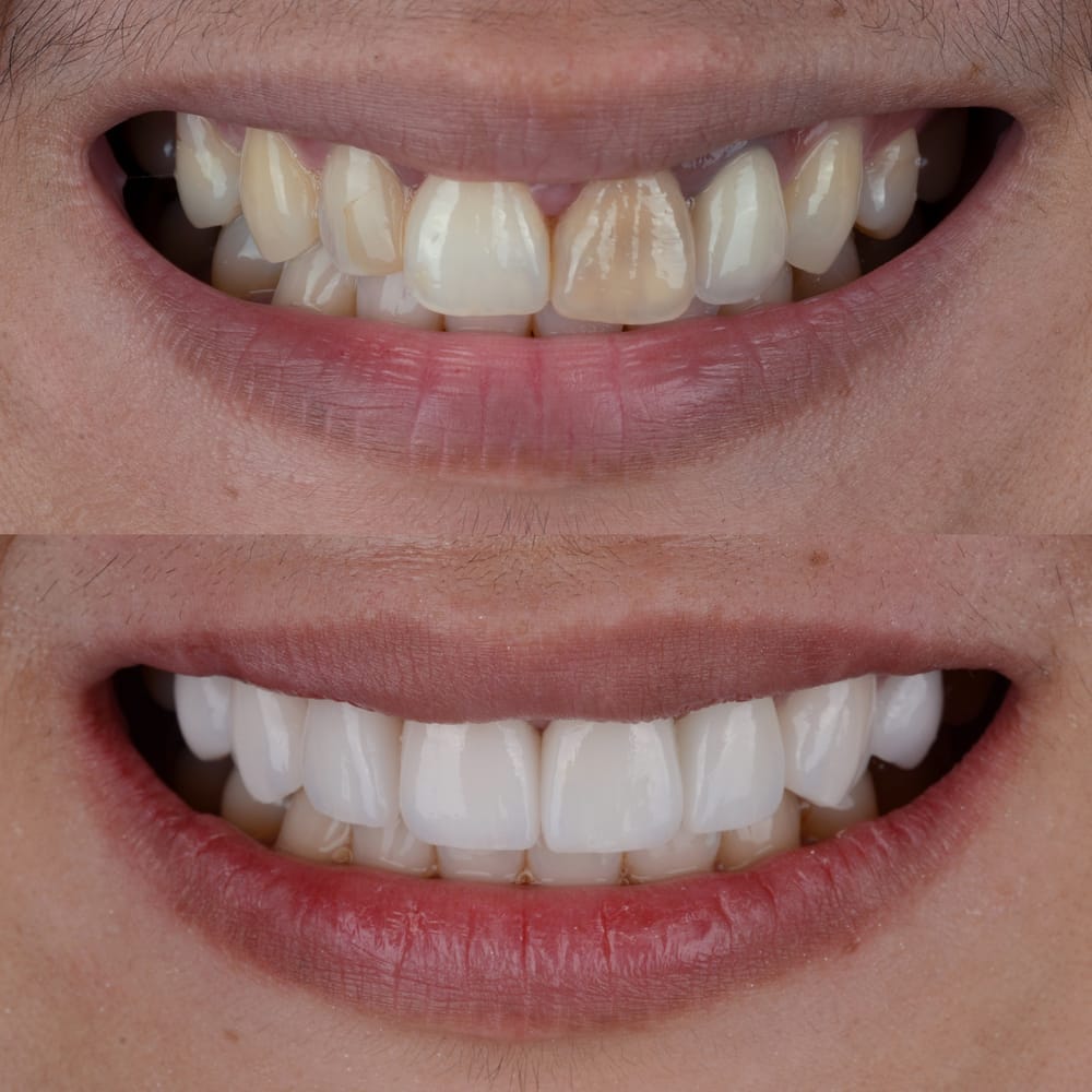 Smile Makeover