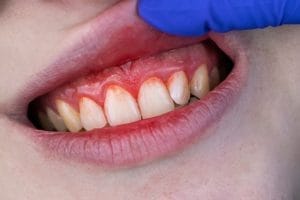 Treat Gum Disease in Utah’s Dry Climate