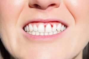 Why Do My Teeth Feel Better When My Gums Bleed?