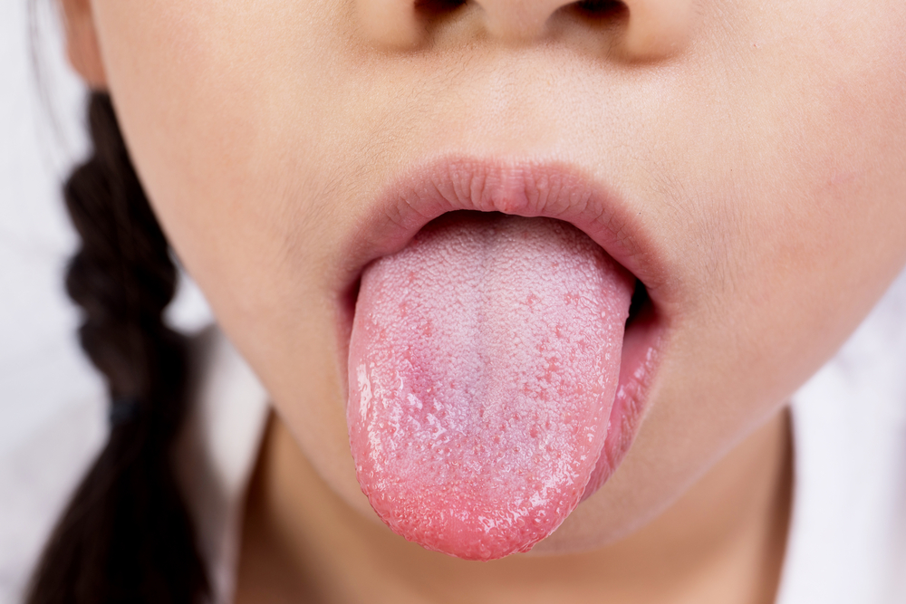 What Causes Dry Mouth